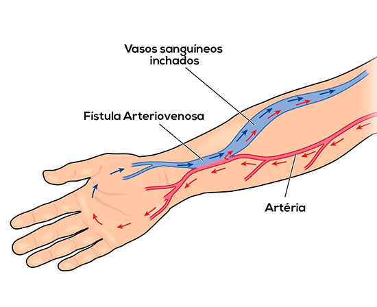 Fístulas Arteriovenosas