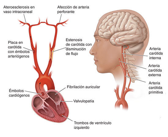 Insuficiencia Vascular Cerebral de Origen Extracraneal